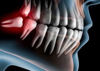 Aquí te contamos todo lo que debes saber sobre la extracción de las cordales