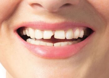 Esto es lo que debes hacer si se te parte un diente