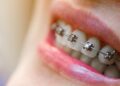 Estos son los cuidados post ortodoncia que debes conocer para mantener tu sonrisa perfecta