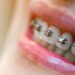 Estos son los cuidados post ortodoncia que debes conocer para mantener tu sonrisa perfecta