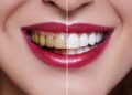 ¿Tienes diseño de sonrisa? Descubre cómo cuidarlo y qué factores pueden afectarlo