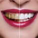 ¿Tienes diseño de sonrisa? Descubre cómo cuidarlo y qué factores pueden afectarlo