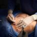Insólito: hombre se endeuda por cirugía estética de su pareja y ella le terminó