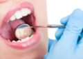 ¿Sensibilidad en los dientes? Puede ser abfracción dental