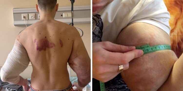 Reconocido influencer que se deformó los bíceps enfrenta posible amputación