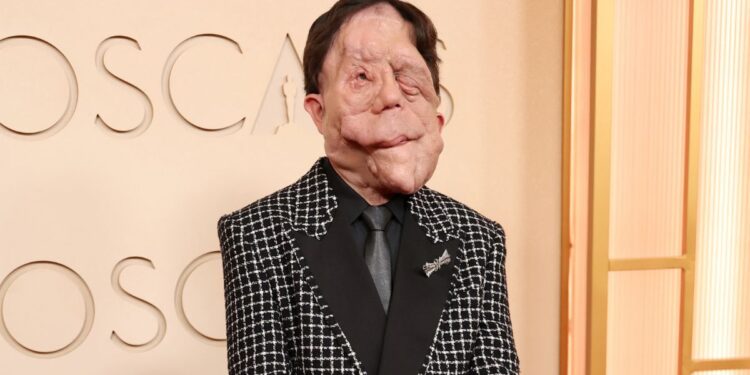 ¿Quién es Adam Pearson y cuál es su enfermedad?